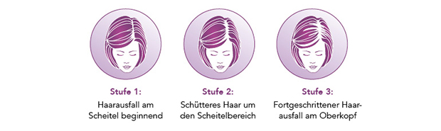 4-REGAINE_BereicheHaarverlust_Frauen_770px.jpg
