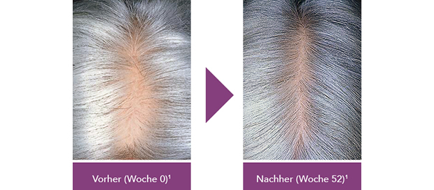 6-REGAINE_Vorher-Nachher_Frauen_770px.jpg