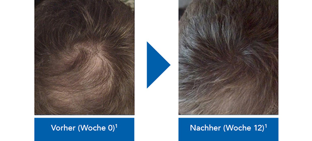 6-REGAINE_Vorher-Nachher_Männer_770px.jpg
