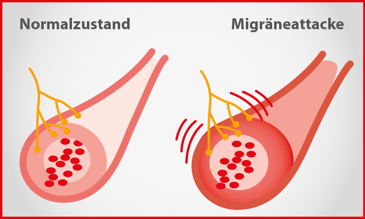 Migraene_2.jpg